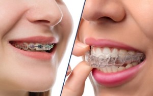 Les différentes techniques de traitement en denture définitives